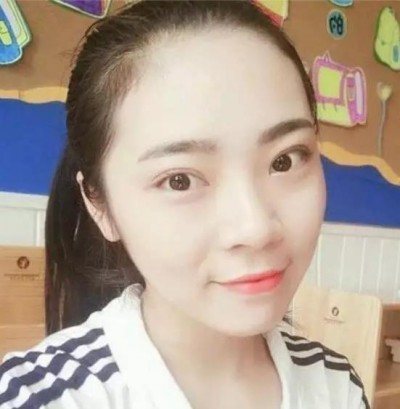 梁医生为我制定了与眼型相对应的超声波双眼皮826 梁医生为我制定了与眼型相对应的超声波双眼皮826