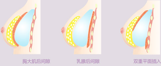 在重庆超雅做自体脂肪丰胸后的效果028 在重庆超雅做自体脂肪丰胸后的效果028