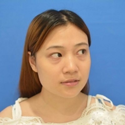 方便到不影响工作的去眼袋方法——超声波去眼袋！341