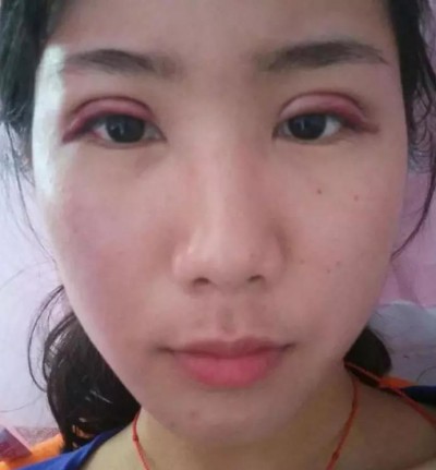 超 声 波双眼 皮,美丽自己从现在开始 超 声 波双眼 皮,美丽自己从现在开始