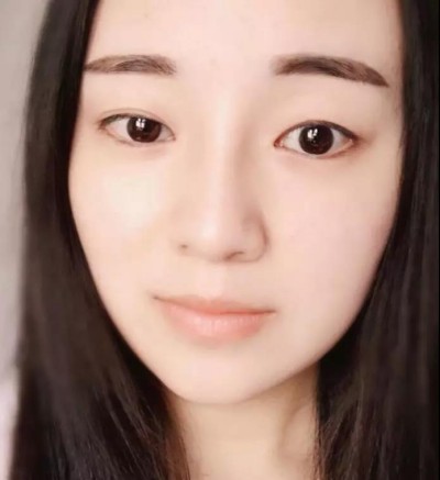 超 声 波双眼 皮,美丽自己从现在开始 超 声 波双眼 皮,美丽自己从现在开始