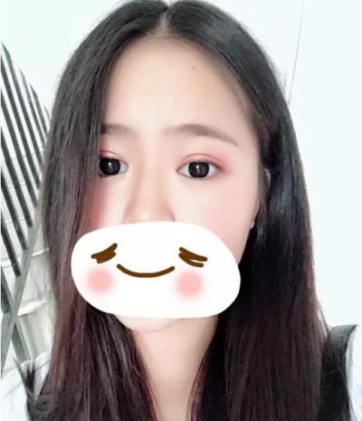 重庆超雅超声波双眼皮,很好很自然659 重庆超雅超声波双眼皮,很好很自然659