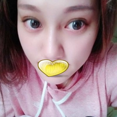 超 声 波为眼袋效果怎么样?就俩字——完美! 超 声 波为眼袋效果怎么样?就俩字——完美!