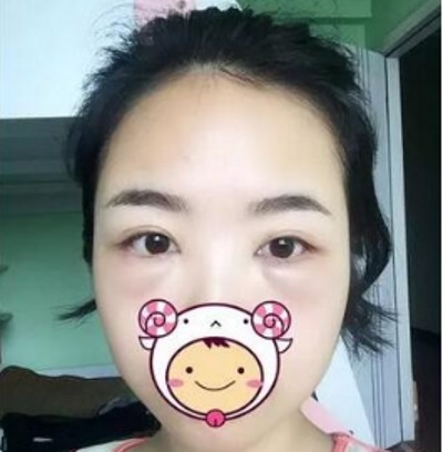 时间不等人,去眼袋要趁早! 时间不等人,去眼袋要趁早!