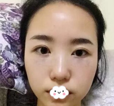 时间不等人,去眼袋要趁早! 时间不等人,去眼袋要趁早!