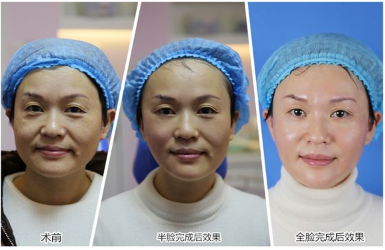 重庆超雅超级微拉美效果是怎样的?619 重庆超雅超级微拉美效果是怎样的?619