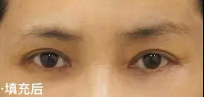 长效玻尿酸