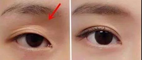 长效玻尿酸