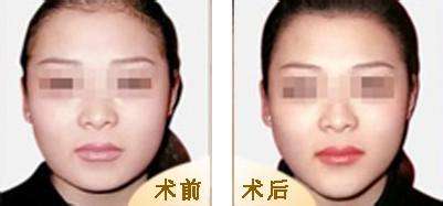 重庆超雅超声波瘦脸方法轻松拥有巴掌小V脸!140 重庆超雅超声波瘦脸方法轻松拥有巴掌小V脸!140