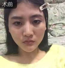 重庆超雅自体脂肪丰面真心挺好得! 重庆超雅自体脂肪丰面真心挺好得!