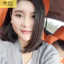 重庆超雅自体脂肪丰面真心挺好得! 重庆超雅自体脂肪丰面真心挺好得!