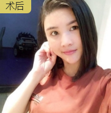 重庆超雅自体脂肪丰面真心挺好得! 重庆超雅自体脂肪丰面真心挺好得!