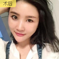 重庆超雅自体脂肪丰面真心挺好得! 重庆超雅自体脂肪丰面真心挺好得!