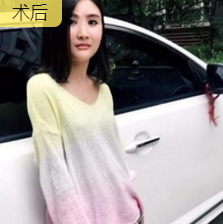 重庆超雅自体脂肪丰面真心挺好得! 重庆超雅自体脂肪丰面真心挺好得!