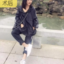 重庆超雅自体脂肪丰面真心挺好得! 重庆超雅自体脂肪丰面真心挺好得!