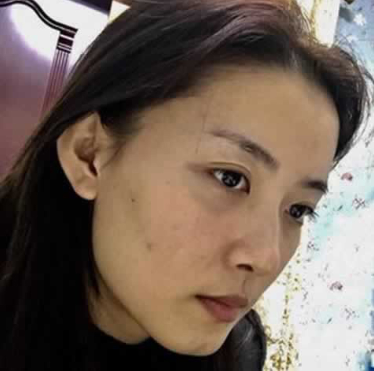 年轻le很多，超 声 波去眼袋无伤去掉眼袋