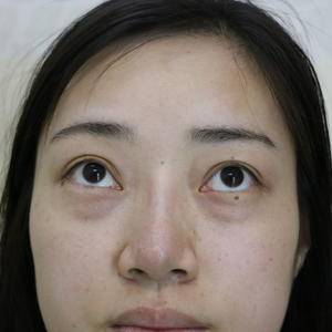 重庆想要去眼袋去哪里呢——超雅超 声 波去眼袋 重庆想要去眼袋去哪里呢——超雅超 声 波去眼袋