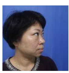 想要成功去眼袋可以选择超声波去眼袋673 想要成功去眼袋可以选择超声波去眼袋673