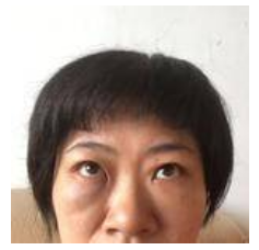 想要成功去眼袋可以选择超声波去眼袋673 想要成功去眼袋可以选择超声波去眼袋673