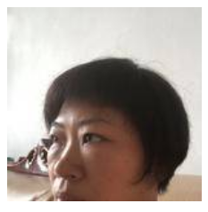 想要成功去眼袋可以选择超声波去眼袋673 想要成功去眼袋可以选择超声波去眼袋673