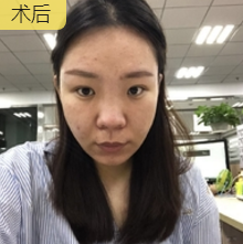 重庆超雅超声波瘦脸,轻松搞定脸大问题143 重庆超雅超声波瘦脸,轻松搞定脸大问题143