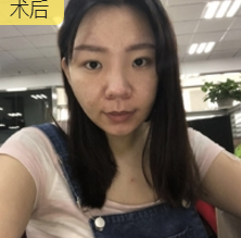 重庆超雅超声波瘦脸,轻松搞定脸大问题143 重庆超雅超声波瘦脸,轻松搞定脸大问题143