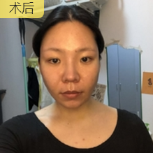 重庆超雅超声波瘦脸,轻松搞定脸大问题143 重庆超雅超声波瘦脸,轻松搞定脸大问题143