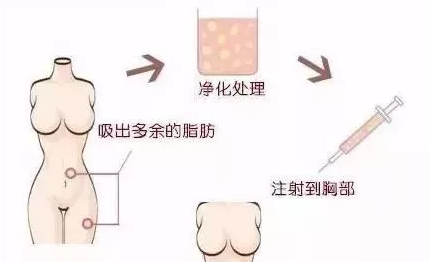 重庆超雅超声波自体脂肪丰胸让你成为“胸”霸！942