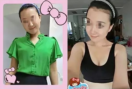 重庆超雅超声波自体脂肪丰胸让你成为“胸”霸！942