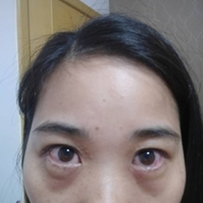 超声波去眼袋让我在演员这条路上走的顺风顺水！458