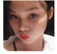 去眼袋日记——我与超雅的结缘来自超声波去眼袋608