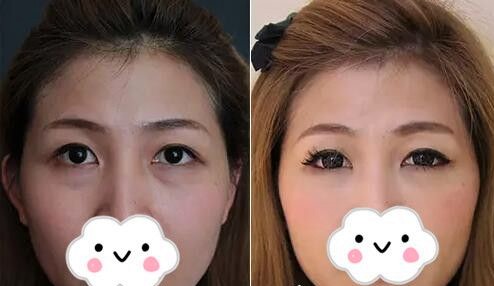 重庆超雅超声波去眼袋让你青春定格383 重庆超雅超声波去眼袋让你青春定格383