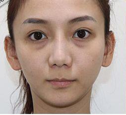 严重的眼袋,超声波去眼袋分分钟去掉404 严重的眼袋,超声波去眼袋分分钟去掉404