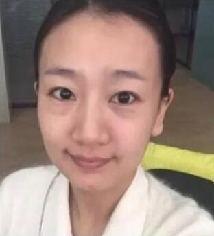 想要闪亮的眼睛超声波去眼袋你别无选择533 想要闪亮的眼睛超声波去眼袋你别无选择533
