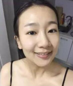 想要闪亮的眼睛超声波去眼袋你别无选择533 想要闪亮的眼睛超声波去眼袋你别无选择533