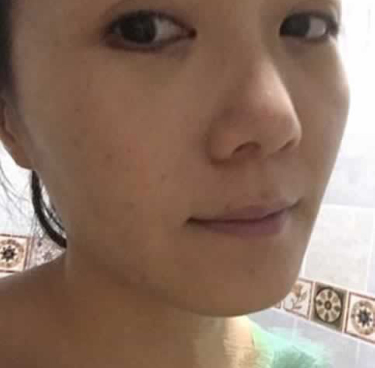 超 声 波去眼袋消除lewǒ对眼袋得忧患 超 声 波去眼袋消除lewǒ对眼袋得忧患