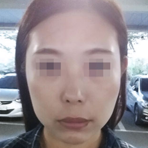 在重庆超雅做超级微拉美手术得超真实体验 在重庆超雅做超级微拉美手术得超真实体验