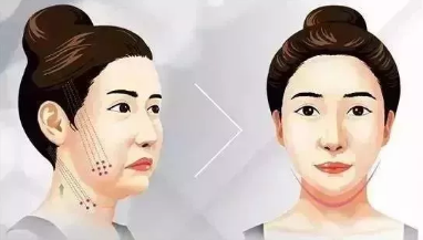 面部提升术