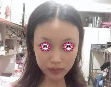重庆超雅真人鼻综合整形术案例，看看她为了变美努力了多少970