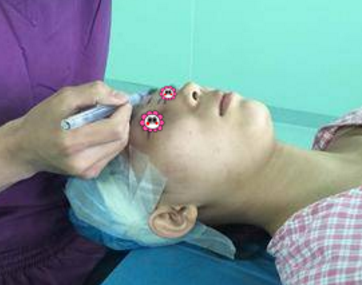 重庆超雅真人鼻综合整形术案例，看看她为了变美努力了多少970