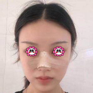 重庆超雅真人鼻综合整形术案例，看看她为了变美努力了多少970