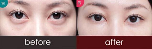 我来告诉大家怎么快速去眼袋902 我来告诉大家怎么快速去眼袋902
