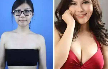 重庆超雅超 声 波自体脂肪丰胸口碑不错! 重庆超雅超 声 波自体脂肪丰胸口碑不错!