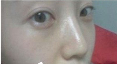 超声波去眼袋去除各种原因引起的眼袋!912 超声波去眼袋去除各种原因引起的眼袋!912