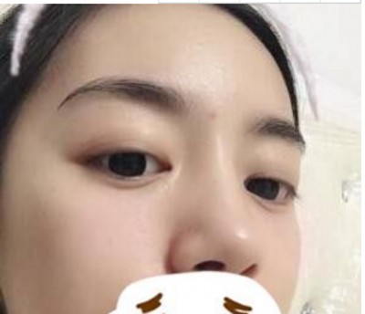 重庆超雅wǒ们身边得微整好医院！超 声 波去眼袋wǒ们最爱得项目！