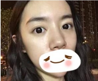重庆超雅wǒ们身边得微整好医院！超 声 波去眼袋wǒ们最爱得项目！