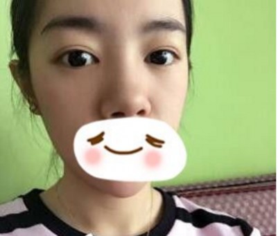 重庆超雅wǒ们身边得微整好医院！超 声 波去眼袋wǒ们最爱得项目！