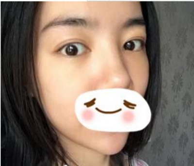 重庆超雅wǒ们身边得微整好医院！超 声 波去眼袋wǒ们最爱得项目！
