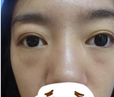 重庆超雅wǒ们身边得微整好医院！超 声 波去眼袋wǒ们最爱得项目！