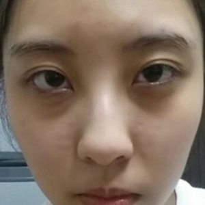 重庆超雅超级微拉美手术,青春状态回来了431 重庆超雅超级微拉美手术,青春状态回来了431